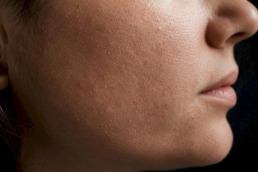 Close-up of dry, rough damaged facial skin